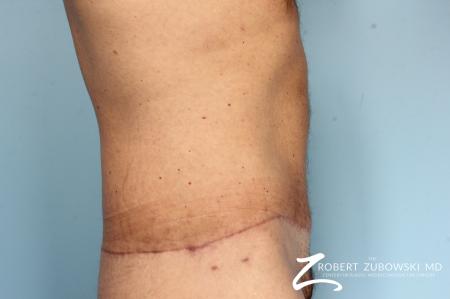 Body Lift: Patient 8 - After Image 3