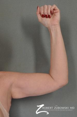 Arm Lift: Patient 1 - After Image 1