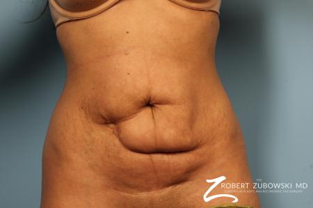 Tummy Tuck: Patient 8 - Before Image 1
