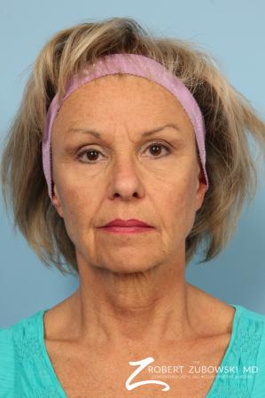 Facelift: Patient 3 - Before Image 1