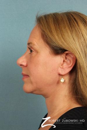 Neck Lift: Patient 5 - After Image 2