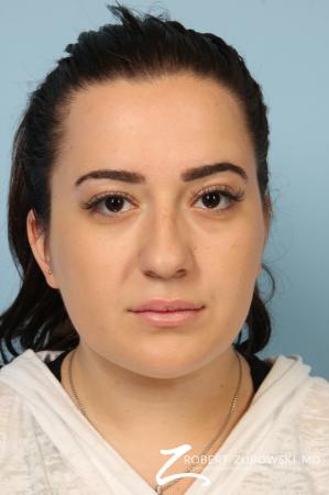 Rhinoplasty: Patient 21 - Before Image 1
