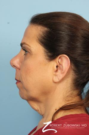 Chin Augmentation: Patient 4 - Before and After Image 3