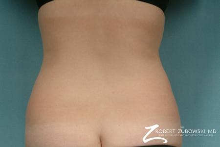 Liposuction: Patient 31 - Before Image 2