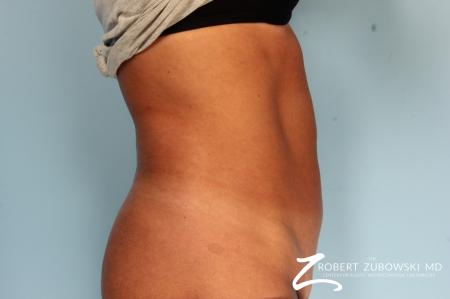 CoolSculpting®: Patient 3 - After Image 2