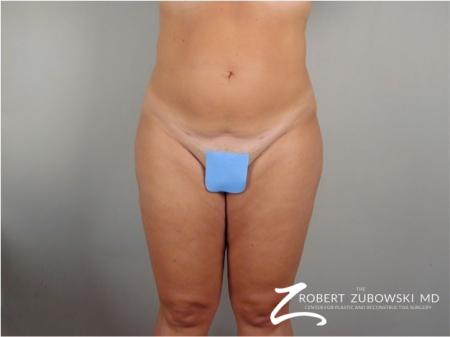 Liposuction: Patient 41 - After Image 1