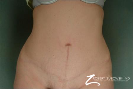 Tummy Tuck: Patient 22 - After Image 1