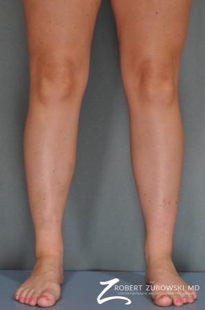 Liposuction: Patient 21 - After Image 2