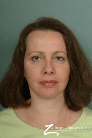 Facelift: Patient 11 - After Image 1
