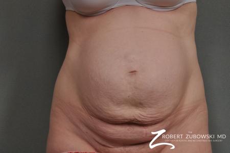 Tummy Tuck: Patient 4 - Before Image 1