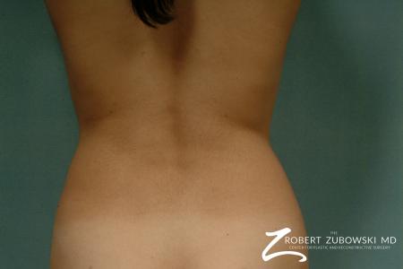 Liposuction: Patient 32 - After Image 2