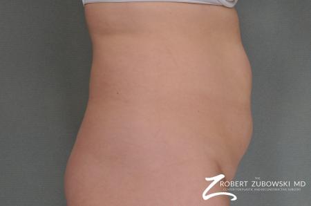 Tummy Tuck: Patient 2 - Before and After Image 2