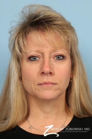 Blepharoplasty: Patient 28 - After Image 1