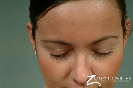 Latisse: Patient 1 - Before Image 1