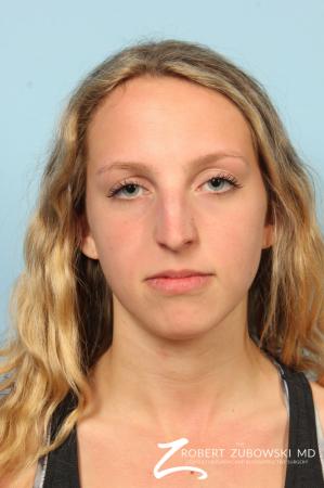 Rhinoplasty: Patient 22 - Before Image 1