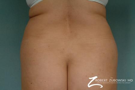 Liposuction: Patient 27 - Before Image 1