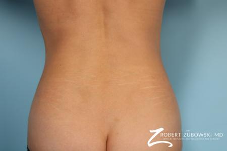 CoolSculpting®: Patient 6 - After Image 1
