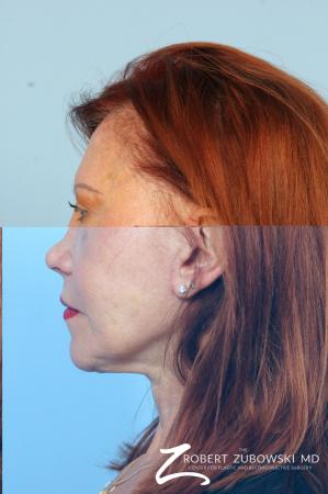 Facelift: Patient 29 - Before Image 2