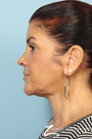 Neck Lift: Patient 10 - After Image 3