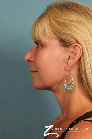 Facelift: Patient 21 - After Image 2