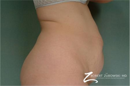 Tummy Tuck: Patient 22 - Before and After Image 2