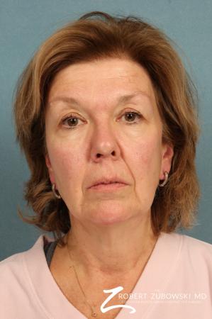Facelift: Patient 18 - Before Image 1