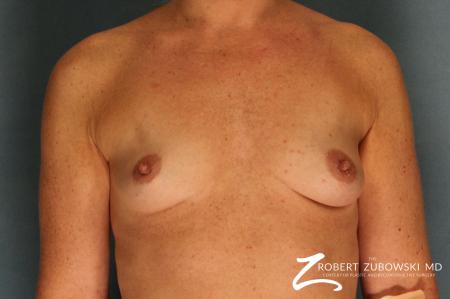 Breast Augmentation: Patient 3 - Before Image 1