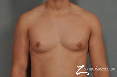 Gynecomastia: Patient 3 - Before Image 1