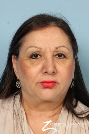 Blepharoplasty: Patient 35 - Before Image 1
