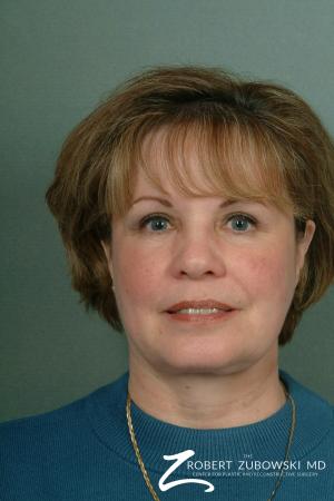 Chin Augmentation: Patient 2 - After Image 1