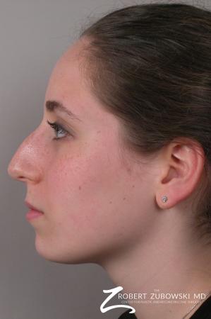 Rhinoplasty: Patient 7 - Before and After Image 2