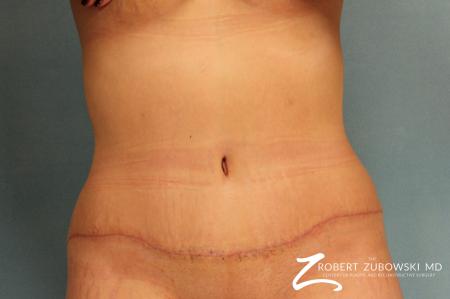 Tummy Tuck: Patient 3 - After Image 1