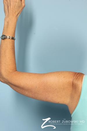 Brachioplasty: Patient 1 - After Image 4