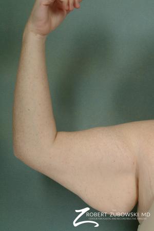 Arm Lift: Patient 3 - Before and After Image 3