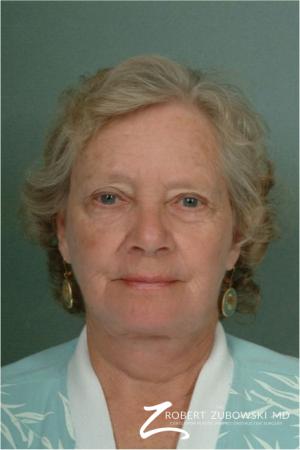 Laser: Patient 7 - After Image 1