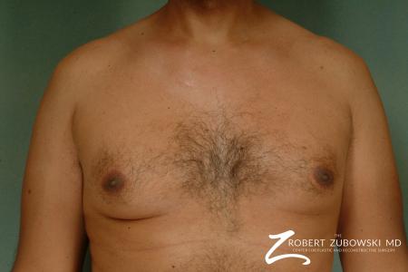 Gynecomastia: Patient 8 - Before Image 1