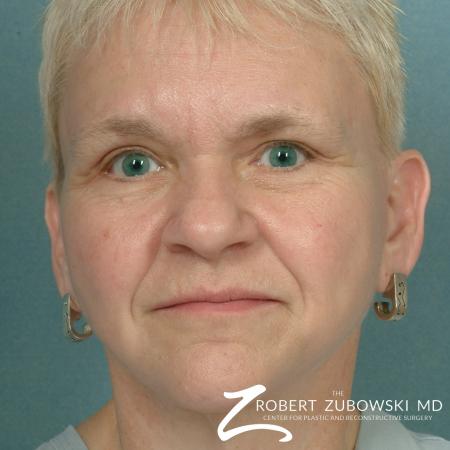 Facelift: Patient 14 - After Image 1
