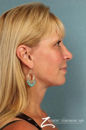 Rhinoplasty: Patient 17 - After Image 2