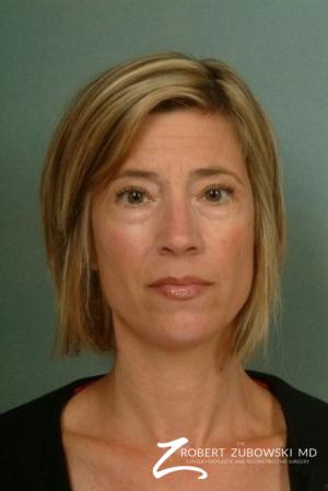 Blepharoplasty: Patient 10 - Before Image 1