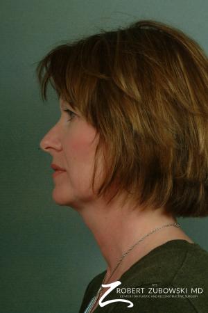 Facelift: Patient 5 - Before and After Image 2