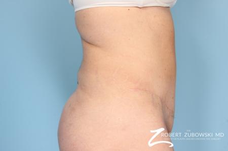 Tummy Tuck: Patient 13 - After Image 2