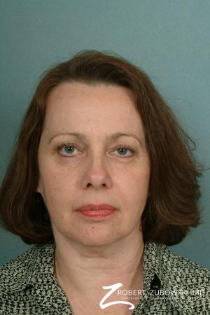 Facelift: Patient 11 - Before Image 1