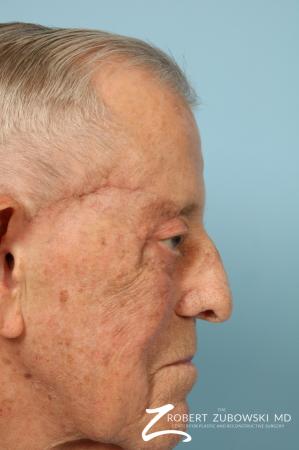 Mohs Closure: Patient 7 - After Image 3