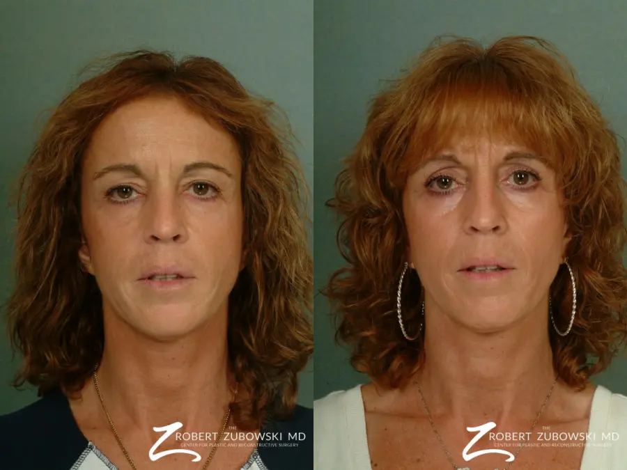 Laser: Patient 3 - Before and After  
