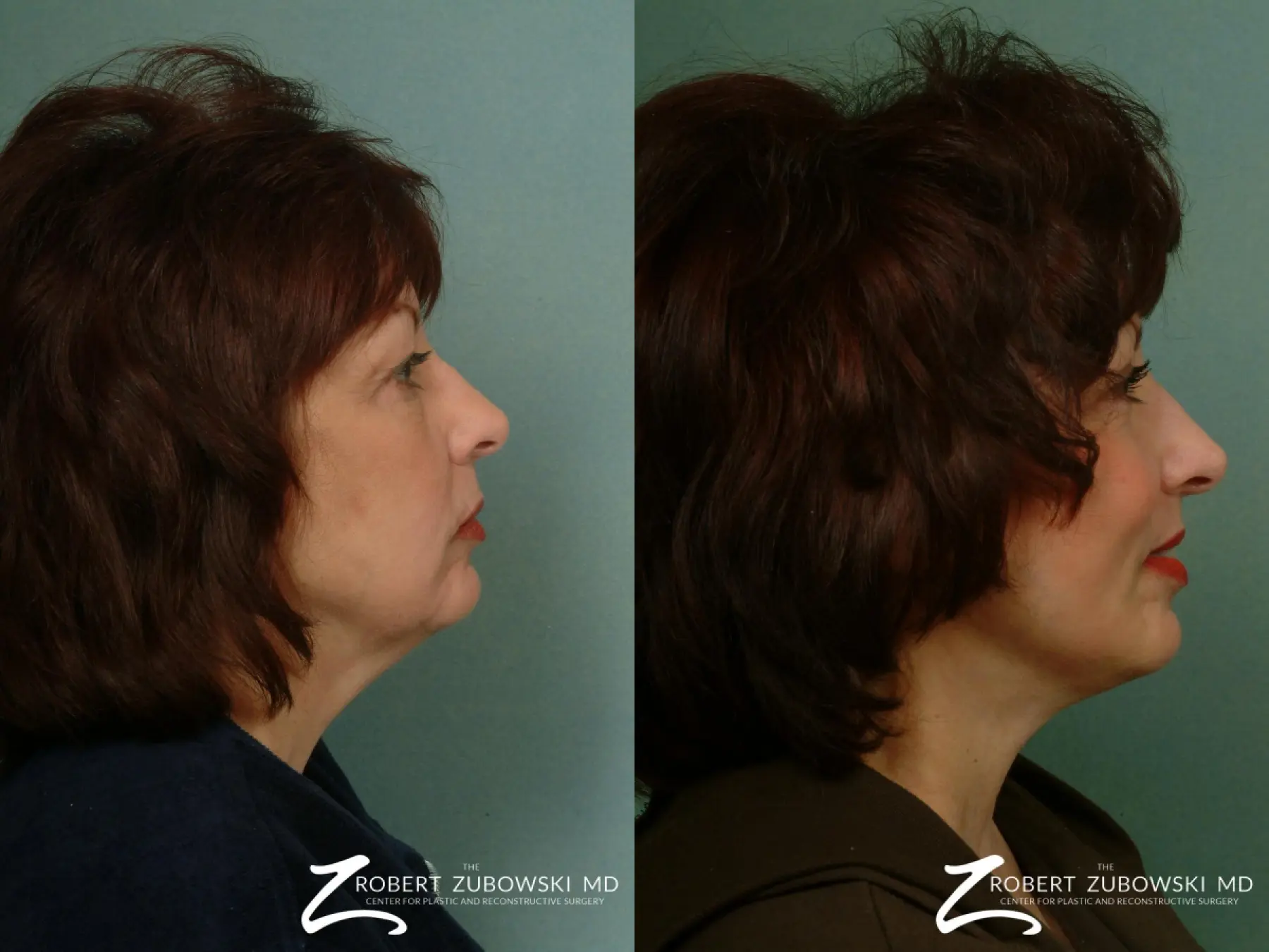 Laser: Patient 2 - Before and After  