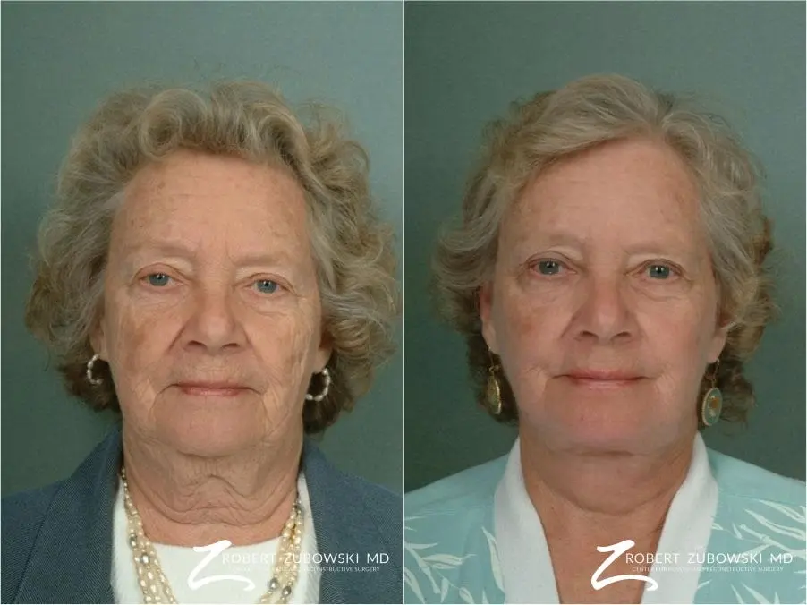 Laser: Patient 8 - Before and After  