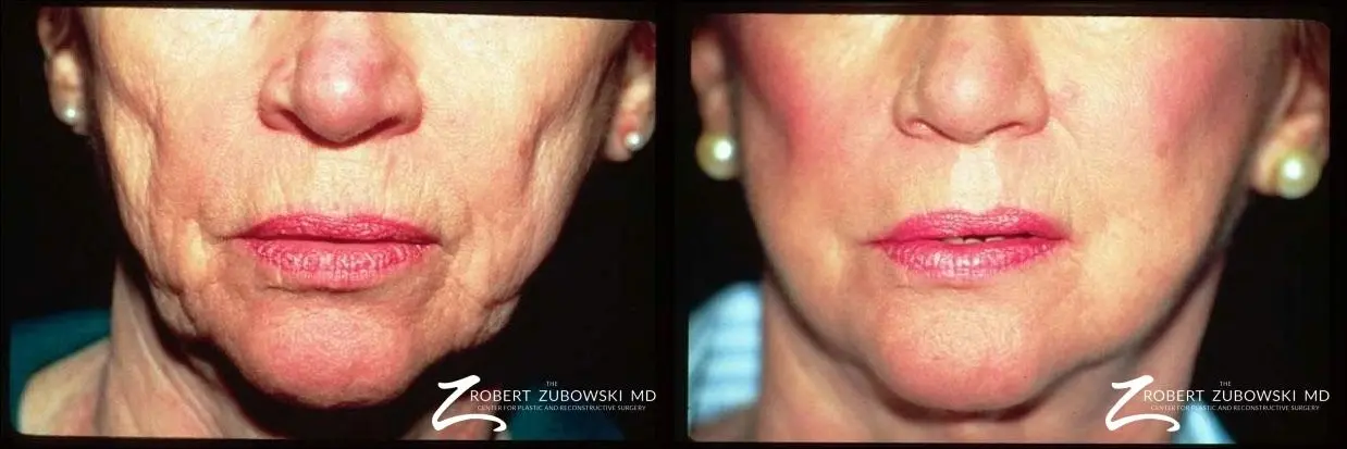 Laser: Patient 9 - Before and After  