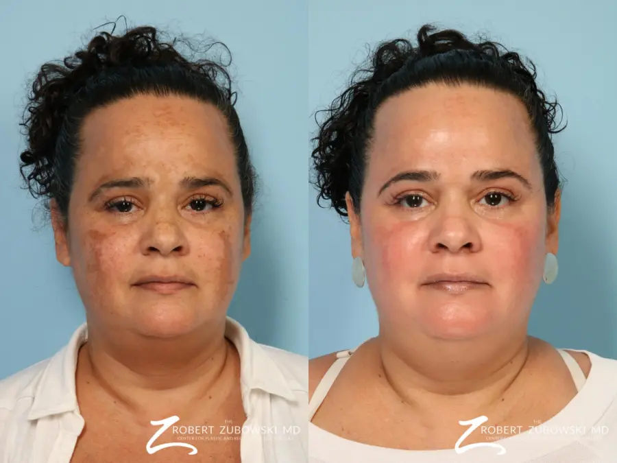 Laser: Patient 9 - Before and After  