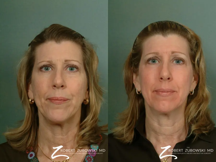 Laser: Patient 5 - Before and After  