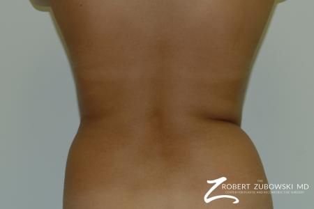 Liposuction: Patient 32 - Before and After Image 2